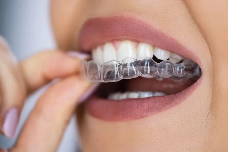 Clear Invisalign aligner being placed on teeth