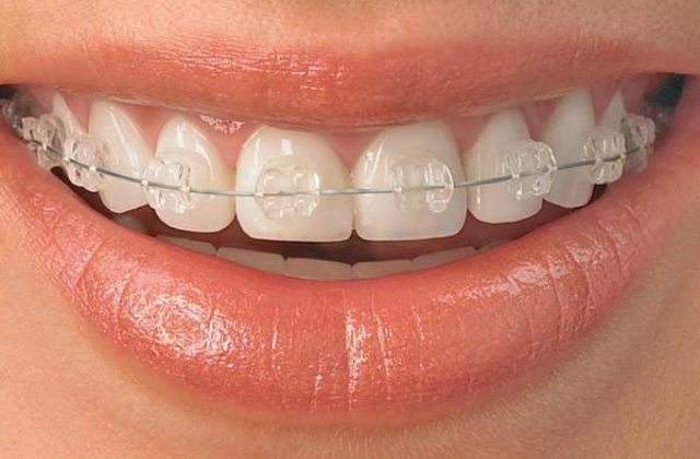 Ceramic tooth-coloured braces