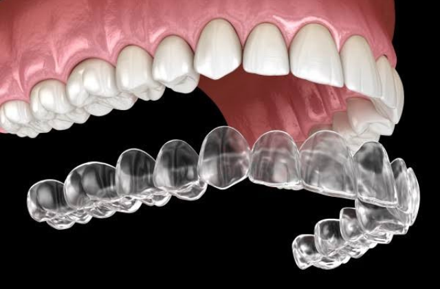 Invisalign clear aligners