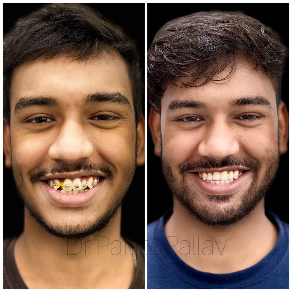 Balaji Dental patient की treatment से पहले और बाद की smile