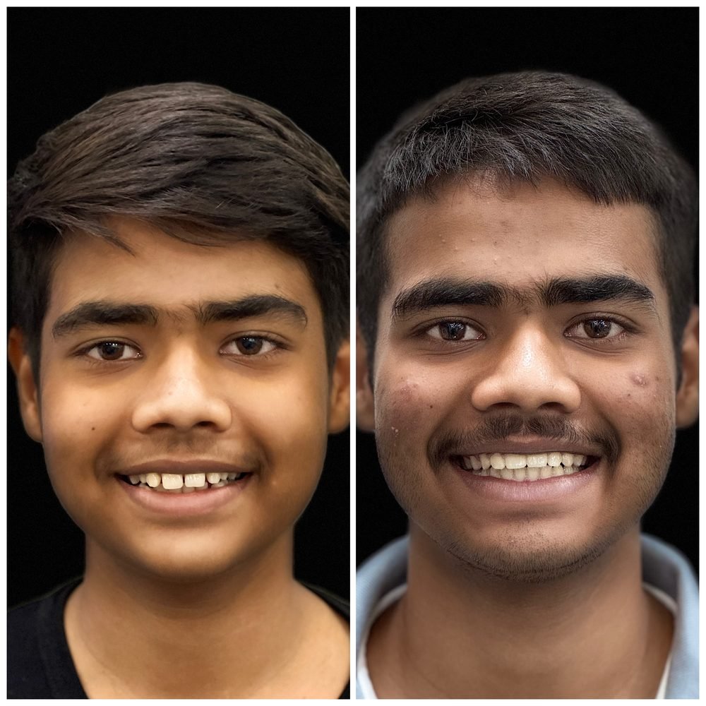 Balaji Dental patient की treatment से पहले और बाद की smile