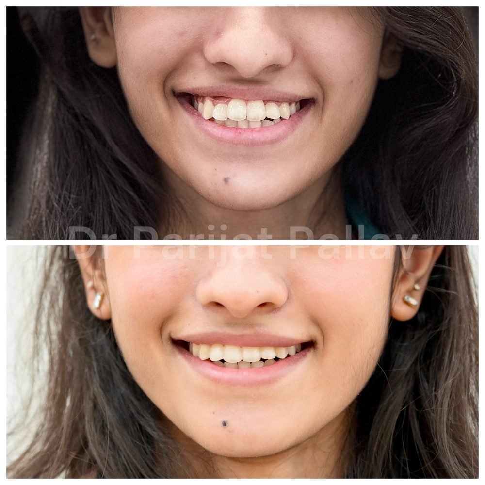 Balaji Dental patient की treatment से पहले और बाद की smile