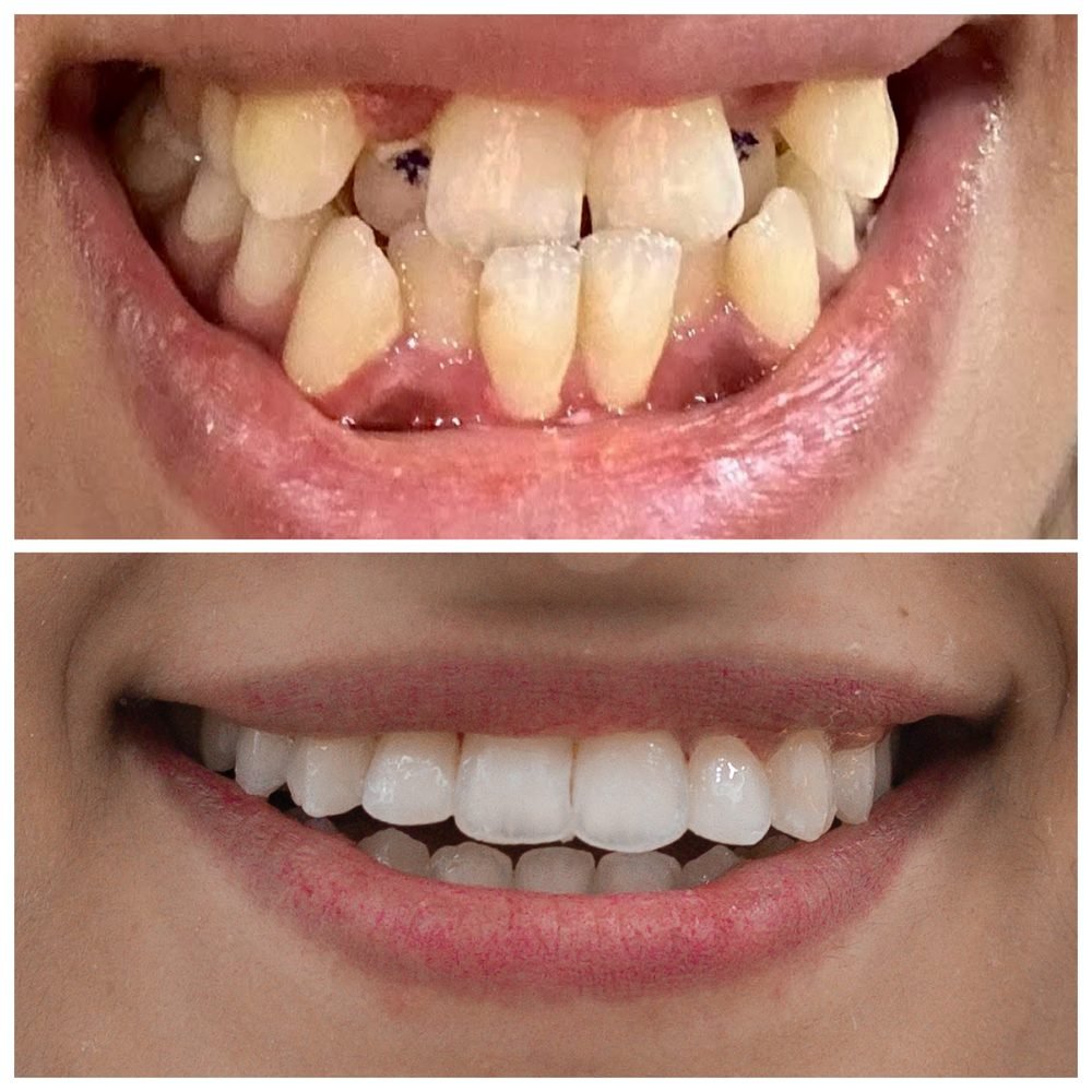 Balaji Dental patient की treatment से पहले और बाद की smile