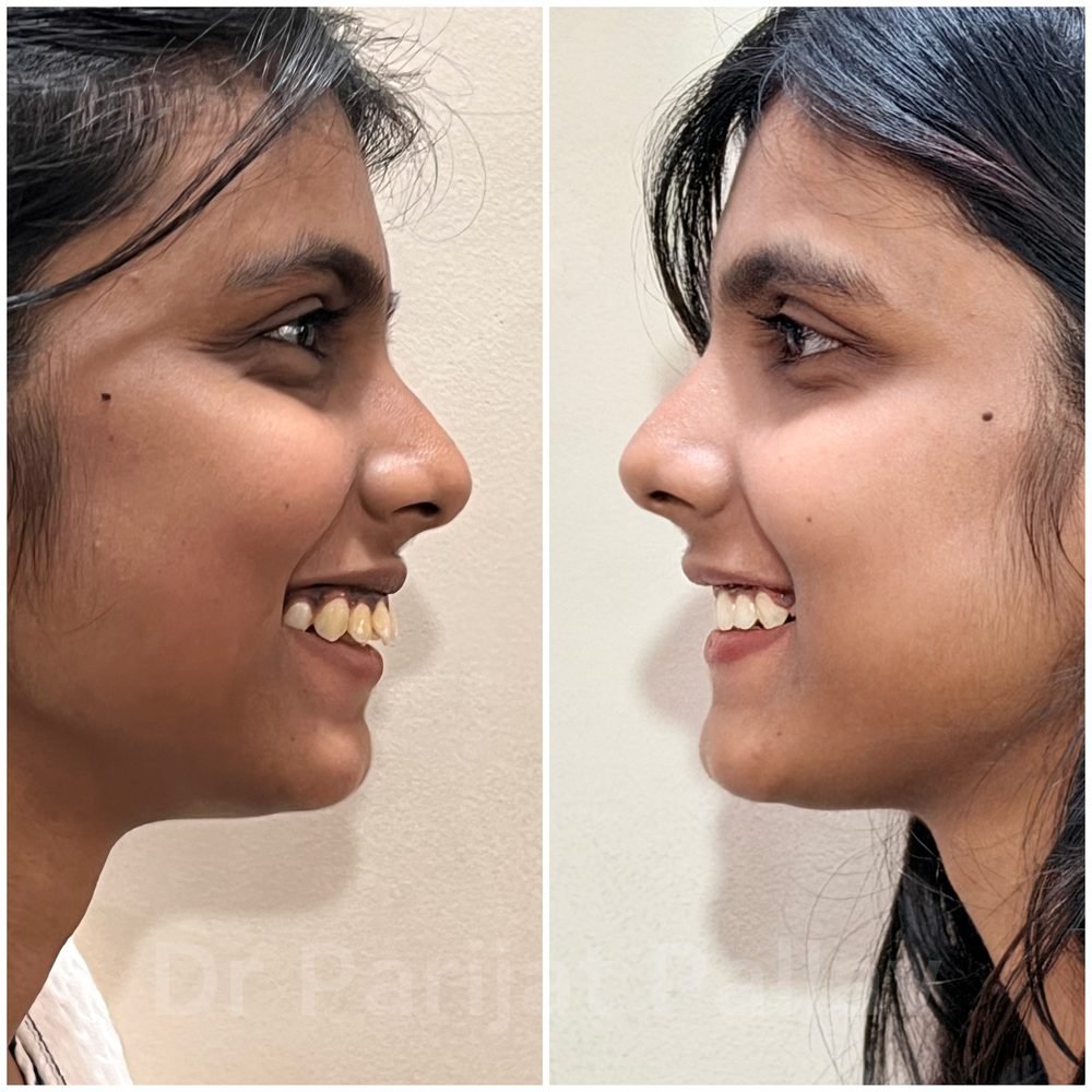 Balaji Dental patient की treatment से पहले और बाद की smile