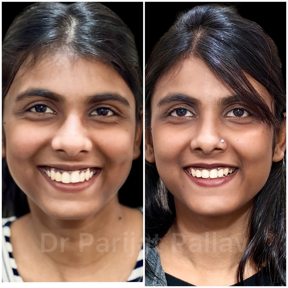 Balaji Dental patient की treatment से पहले और बाद की smile