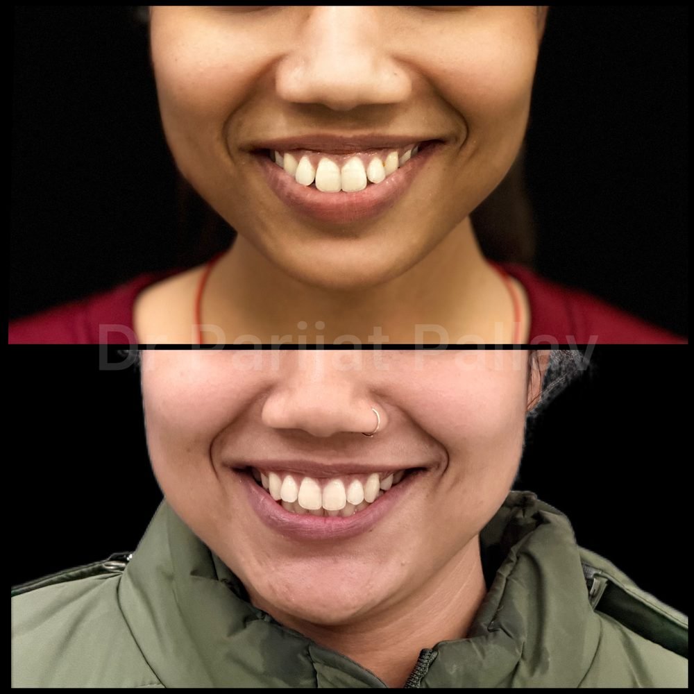 Balaji Dental patient की treatment से पहले और बाद की smile