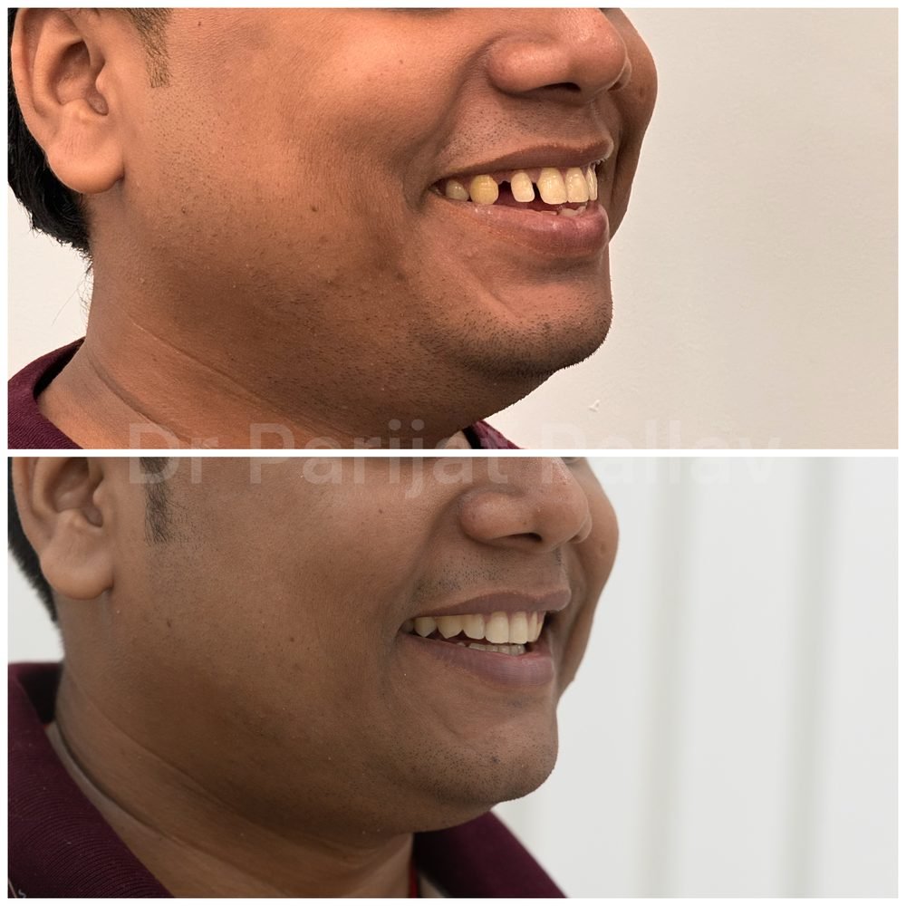 Balaji Dental patient की treatment से पहले और बाद की smile